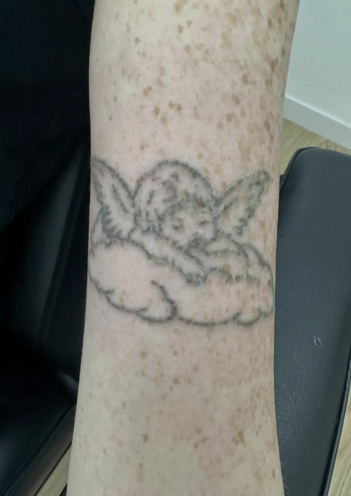 The Chocolate Moose MT | Can A Tattoo Be Removed 100%? laser tattoo removal before and after
