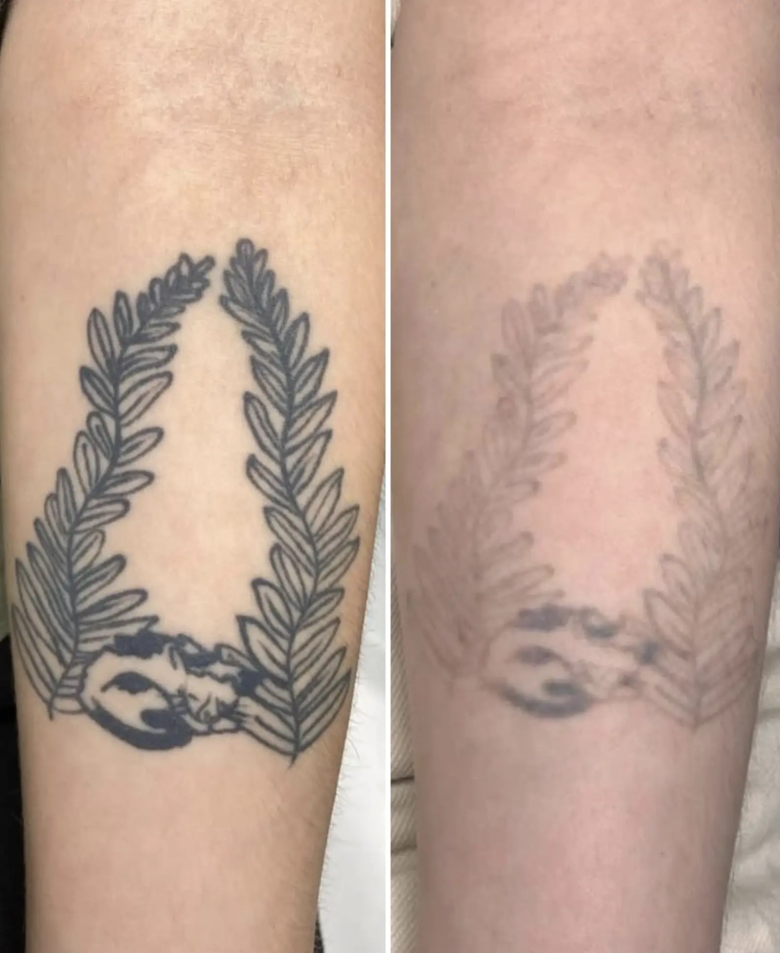 The Chocolate Moose MT | Can A Tattoo Be Removed 100%? laser tattoo removal near me